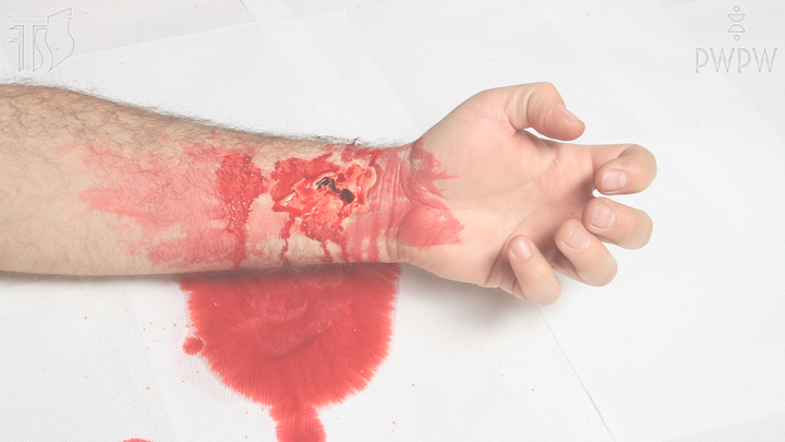 Co należy zrobić w przypadku poważnego zranienia przedramienia wywołującego krwotok?